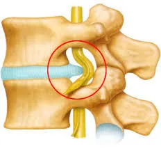 椎間板ヘルニアの原因