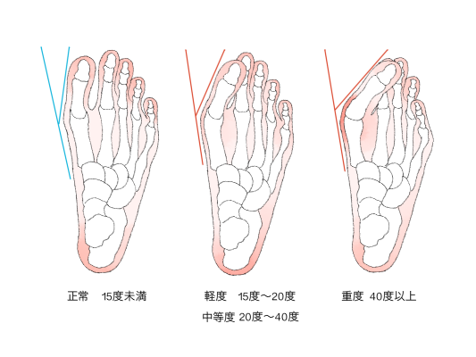 外反母趾の原因