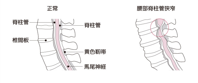 脊柱管狭窄症の原因