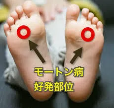 モートン病の原因